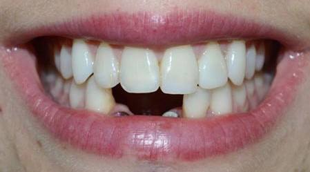 Dental Implant Before